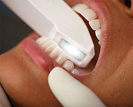 Intraoral Scanning