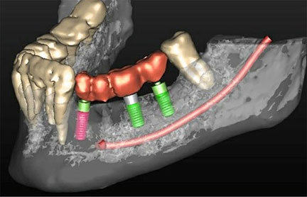 3D CBCT Scan