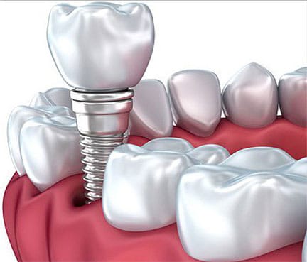 Dental Implant With Crown