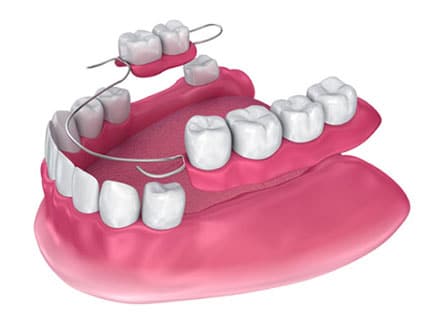 Removable Partial Dentures