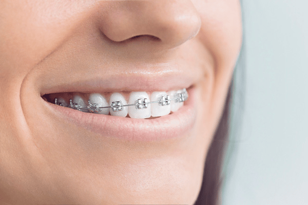 Braces - Hallstone Dentistry