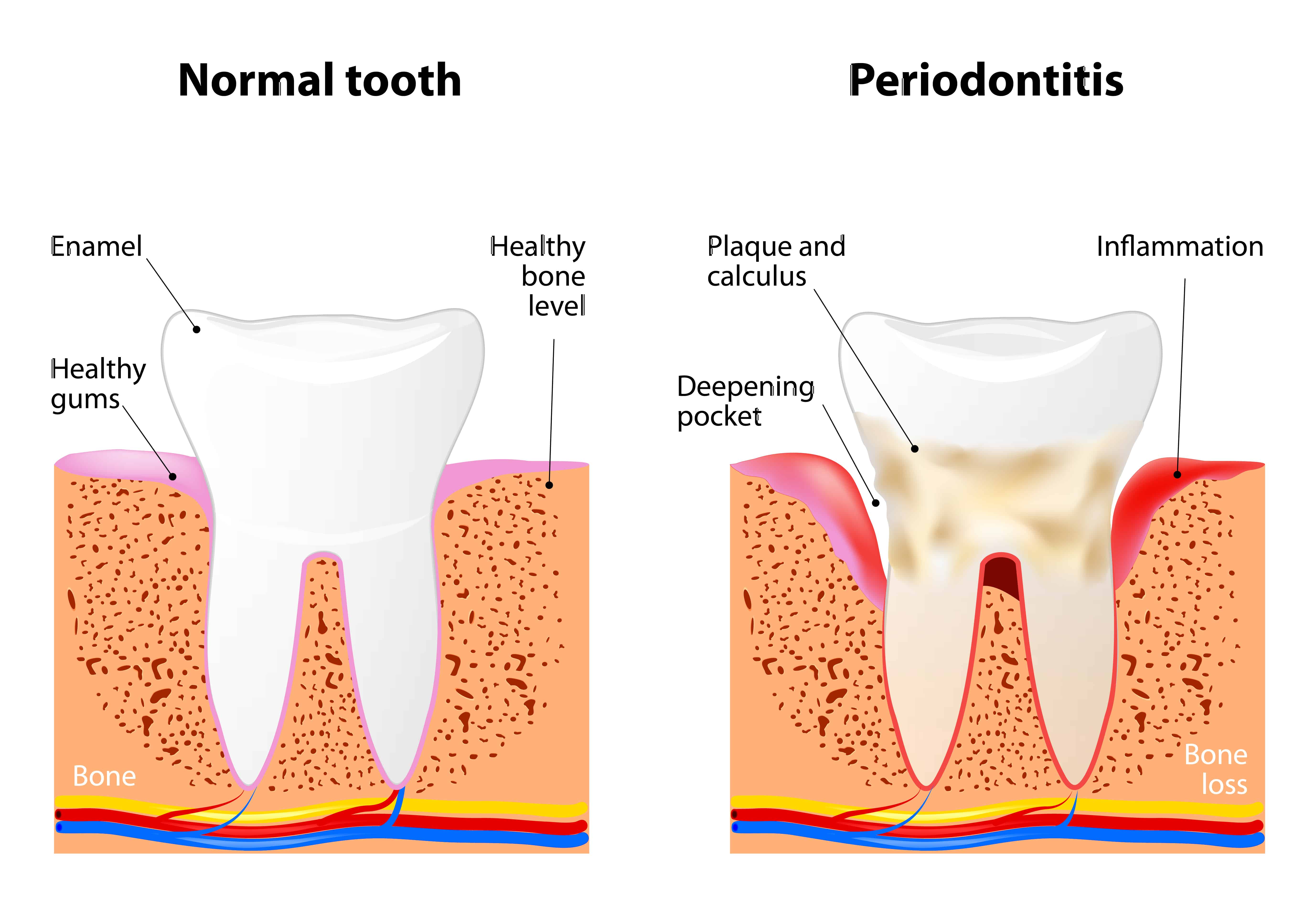 Hallstone Dentistry - Periodontics