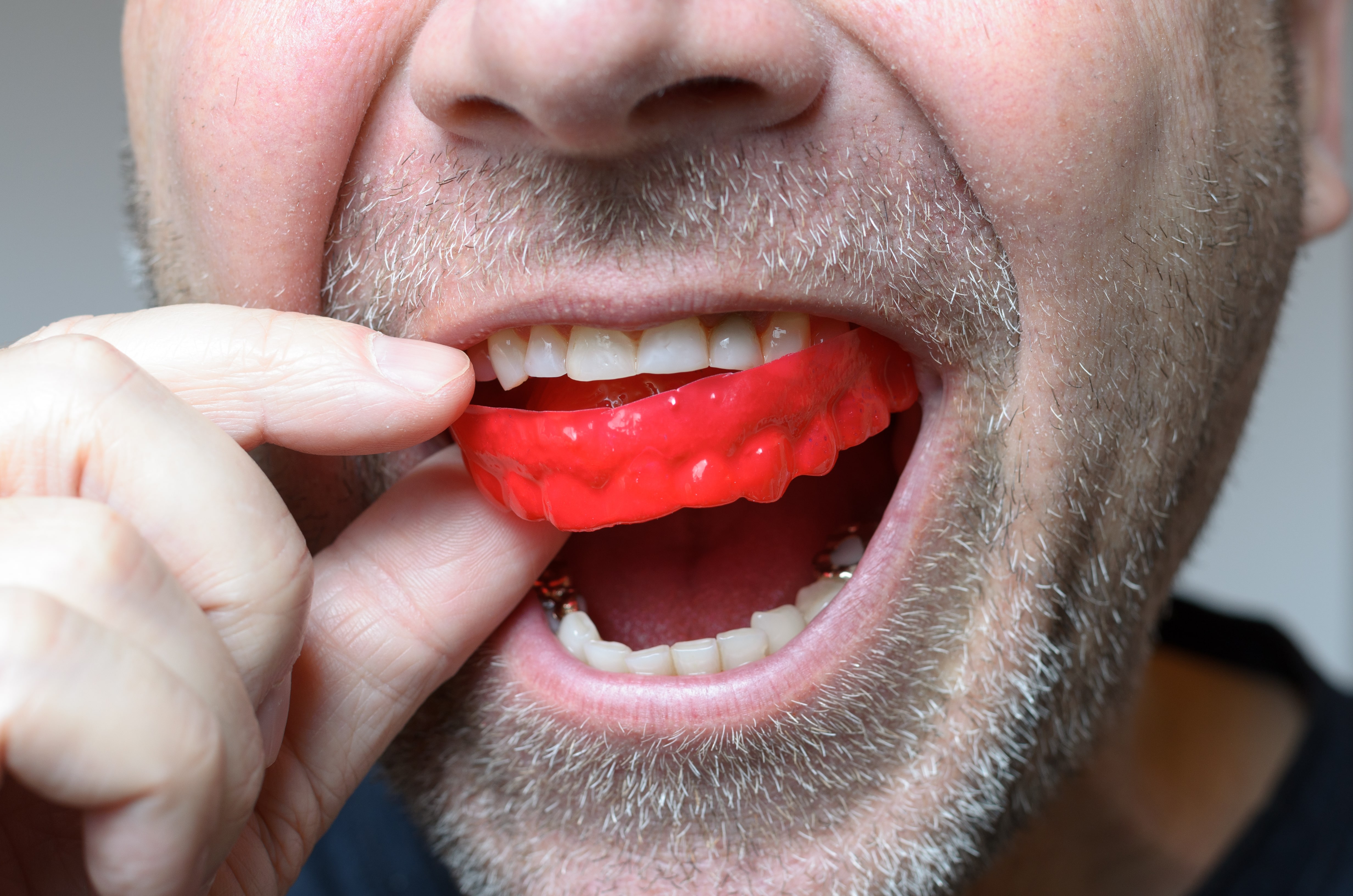 Mouth Guards