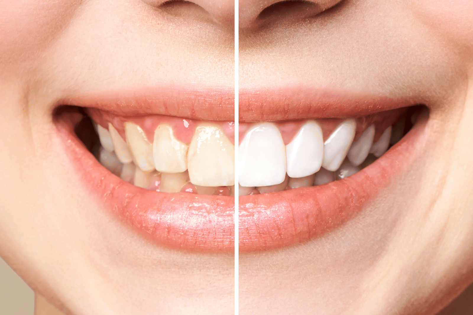 Teeth Whitening - Hallstone Dentistry